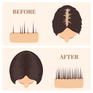 A before and after picture of hair growth.